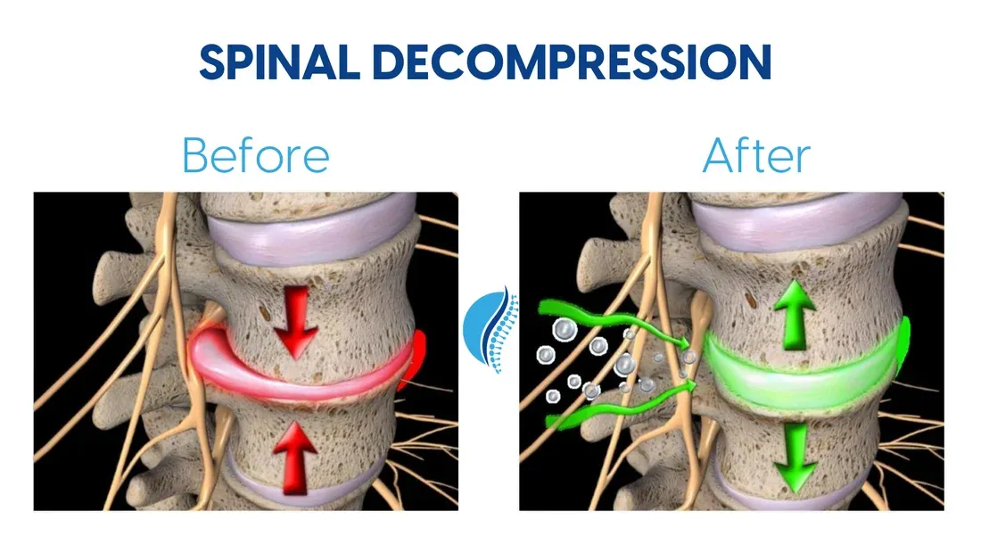 Before-and-after diagram of a spinal disc: compressed and pressing on a nerve before treatment, then decompressed and rehydrated after DRX 9000 spinal decompression.
