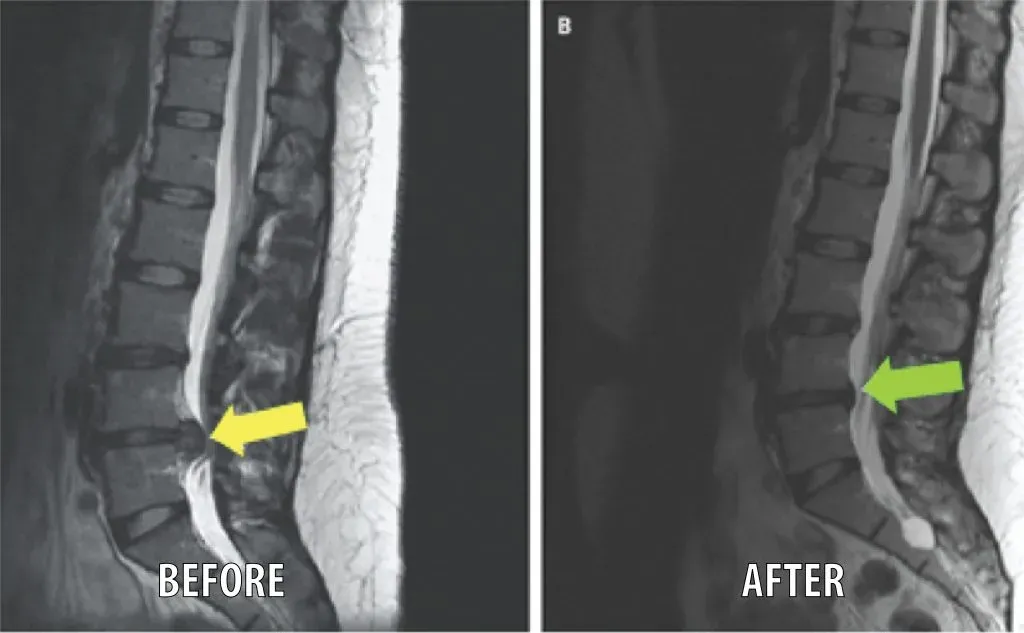 Resonancias de antes y después de un paciente real que muestran una hernia de disco L4-L5 reducida tras la descompresión espinal DRX 9000.