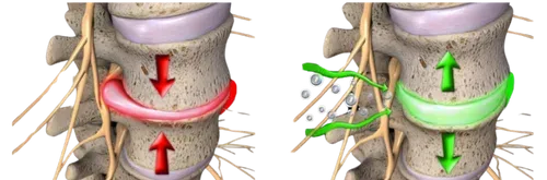 Illustration of how non-surgical spinal decompression relieves herniated disc.